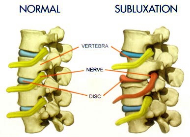 Valley Center Chiropractor | Valley Center chiropractic What is a Subluxation |  CA |